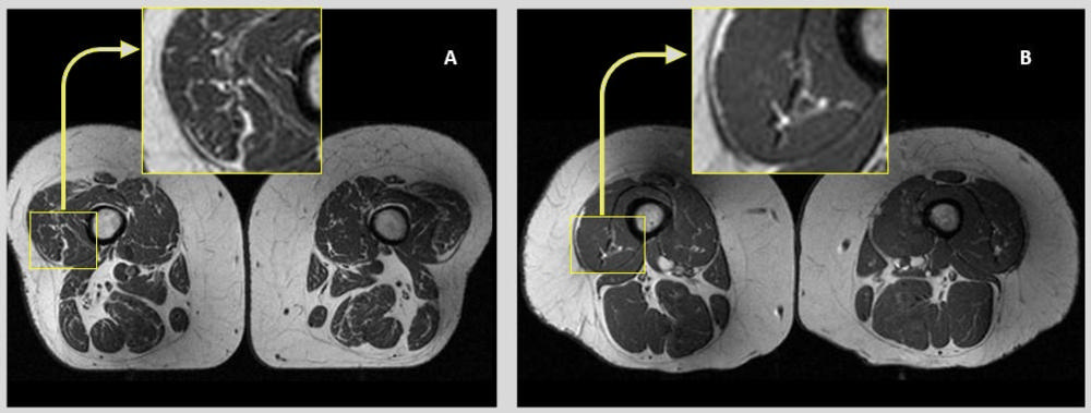 超加工食品或与大腿肌肉脂肪浸润有关，MRI 研究揭示潜在关联 封面