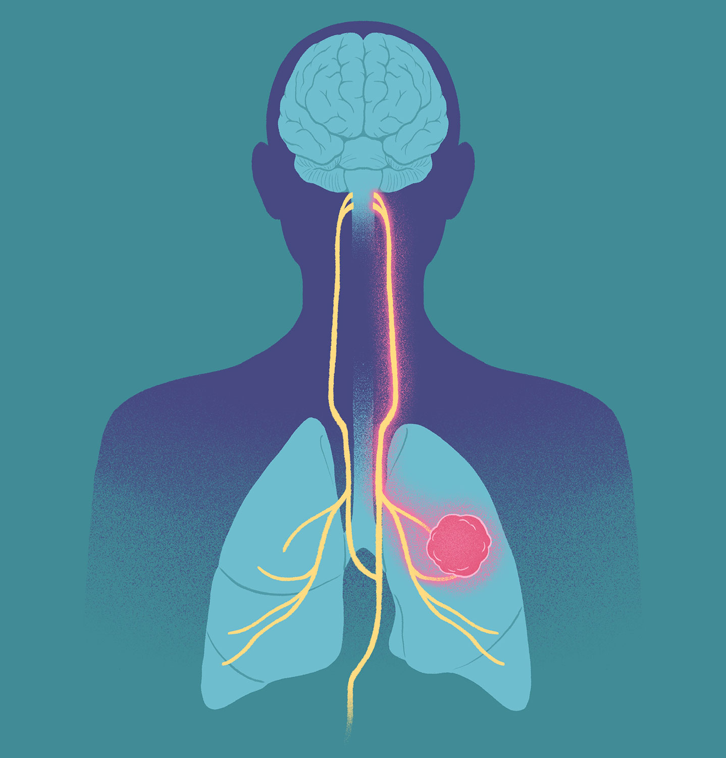 肺癌如何劫持你的神经?Science揭示癌症恶病质背后的隐藏通路 封面